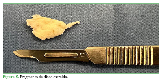 Fragmento de disco extraído.