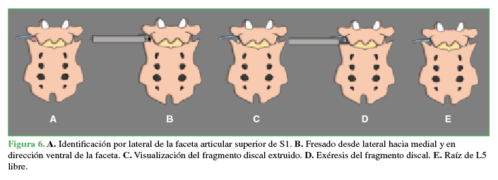 A. Identificación por
lateral de la faceta articular superior de S1. B. Fresado desde lateral hacia medial y en dirección ventral de la
faceta. C. Visualización del
fragmento discal extruido. D.
Exéresis del fragmento discal. E.
Raíz de L5 libre.