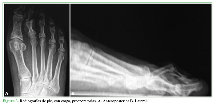 Radiografías de pie, con carga,
preoperatorias. A. Anteroposterior B. Lateral.