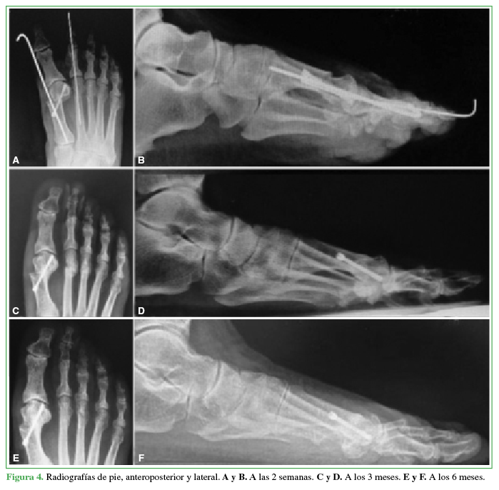 Radiografías de pie, anteroposterior y
lateral. A y B. A las 2 semanas. C y D. A los 3 meses. E y F. A los 6 meses. 

 