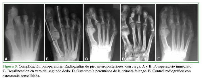 Complicación posoperatoria.
Radiografías de pie, anteroposteriores, con carga. A y B. Posoperatorio inmediato.
C. Desalineación en varo del segundo dedo. D. Osteotomía percutánea de la primera falange. E. Control radiográfico con osteotomía
consolidada.