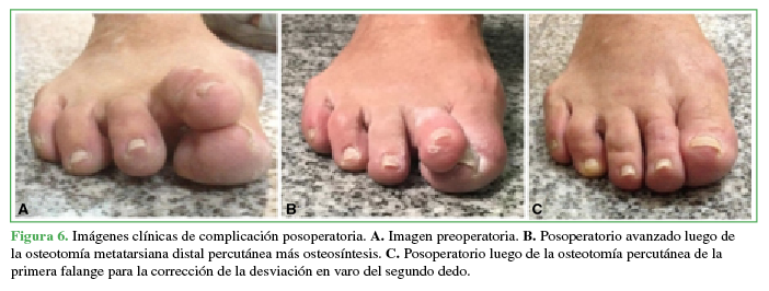Imágenes clínicas de complicación
posoperatoria. A. Imagen
preoperatoria. B. Posoperatorio
avanzado luego de la osteotomía metatarsiana distal percutánea más
osteosíntesis. C. Posoperatorio
luego de la osteotomía percutánea de la primera falange para la corrección de
la desviación en varo del segundo dedo.