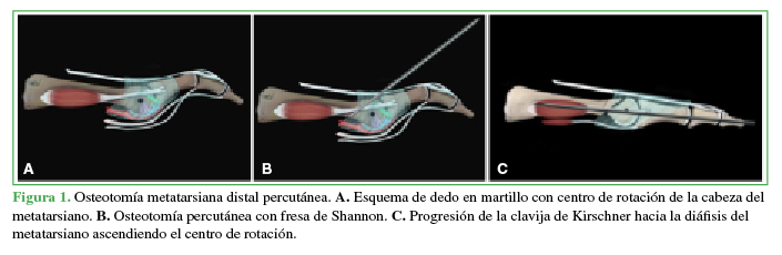 Osteotomía metatarsiana distal
percutánea. A. Esquema de dedo en
martillo con centro de rotación de la cabeza del metatarsiano. B. Osteotomía percutánea con fresa de
Shannon. C. Progresión de la clavija
de Kirschner hacia la diáfisis del metatarsiano ascendiendo el centro de
rotación.