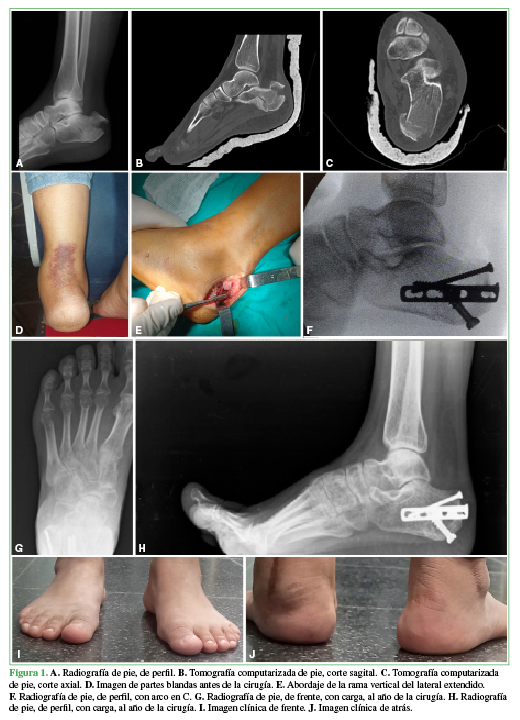 A. Radiografía de pie,
de perfil. B. Tomografía
computarizada de pie, corte sagital. C.
Tomografía computarizada de pie, corte axial. D. Imagen de partes blandas antes de la cirugía. E. Abordaje de la rama vertical del
lateral extendido. 

F.
Radiografía de pie, de perfil, con arco en C. G. Radiografía de pie, de frente, con carga, al año de la cirugía. H. Radiografía de pie, de perfil, con
carga, al año de la cirugía. I.
Imagen clínica de frente. J. Imagen
clínica de atrás.