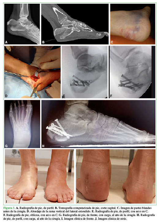  A. Radiografía de pie,
de perfil. B. Tomografía
computarizada de pie, corte sagital. C.
Imagen de partes blandas antes de la cirugía. D. Abordaje de la rama vertical del lateral extendido. E. Radiografía de pie, de perfil, con
arco en C. F. Radiografía de pie,
oblicua, con arco en C. G.
Radiografía de pie, de frente, con carga, al año de la cirugía. H. Radiografía de pie, de perfil, con
carga, al año de la cirugía. I.
Imagen clínica de frente. J. Imagen
clínica de atrás.
