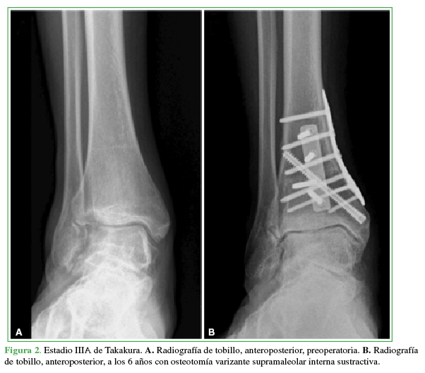 Estadio IIIA de Takakura. A. Radiografía de tobillo, anteroposterior, preoperatoria. B. Radiografía de tobillo,
anteroposterior, a los 6 años con osteotomía varizante supramaleolar interna
sustractiva.