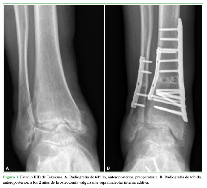 Estadio IIIB de Takakura. A. Radiografía de tobillo,
anteroposterior, preoperatoria. B.
Radiografía de tobillo, anteroposterior, a los 2 años de la osteotomía
valguizante supramaleolar interna aditiva.