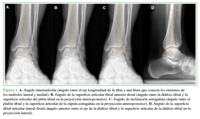 A. Ángulo
intermaleolar (ángulo entre el eje longitudinal de la tibia y una línea que
conecta los extremos de los maléolos lateral y medial). B. Ángulo de la superficie articular tibial anterior distal (ángulo
entre la diáfisis tibial y la superficie articular del pilón tibial en la
proyección anteroposterior). C.
Ángulo de inclinación astragalina (ángulo entre el plafón tibial y la
superficie articular de la cúpula astragalina en la proyección
anteroposterior). D. Ángulo de la
superficie tibial articular lateral distal (ángulo anterior entre el eje de la
diáfisis tibial y la superficie articular de la diáfisis tibial en la
proyección lateral).