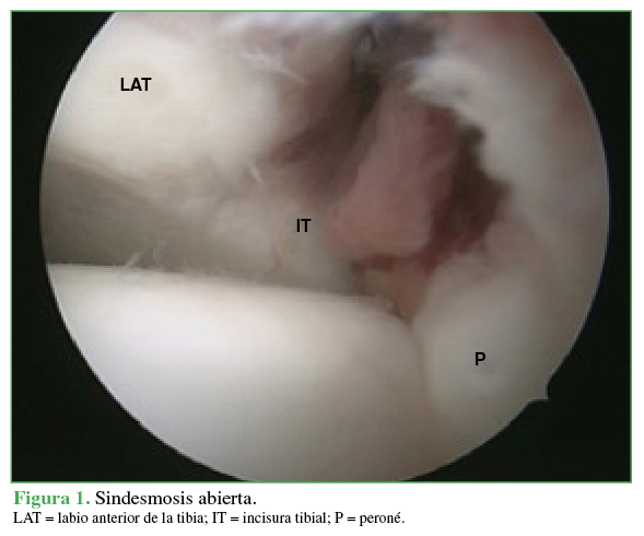 Sindesmosis abierta. LAT = labio anterior de la tibia; IT = incisura tibial; P = peroné.
