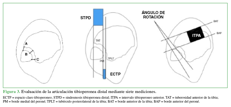 Evaluación de la articulación
tibioperonea distal mediante siete mediciones.