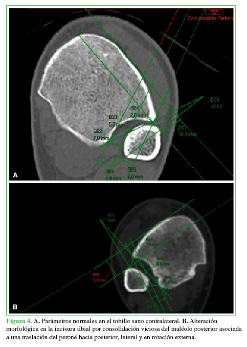 A. Parámetros normales
en el tobillo sano contralateral. B.
Alteración morfológica en la incisura tibial por consolidación viciosa del
maléolo posterior asociada a una traslación del peroné hacia posterior, lateral
y en rotación externa.