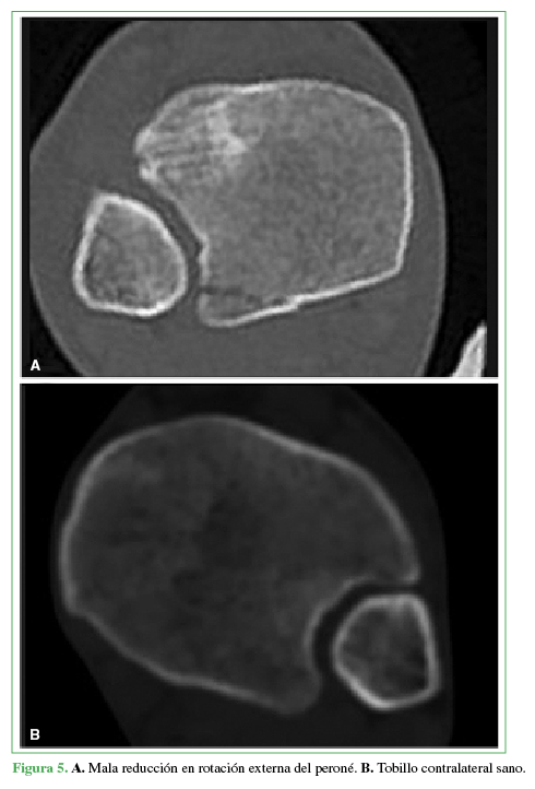 A. Mala reducción en
rotación externa del peroné. B.
Tobillo contralateral sano.