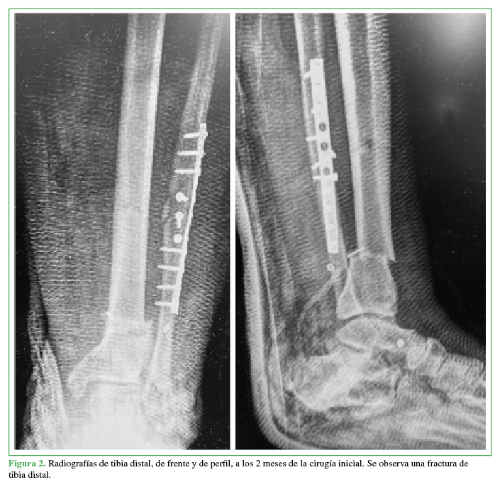 Radiografías de tibia distal, de
frente y de perfil, a los 2 meses de la cirugía inicial. Se observa una
fractura de tibia distal.