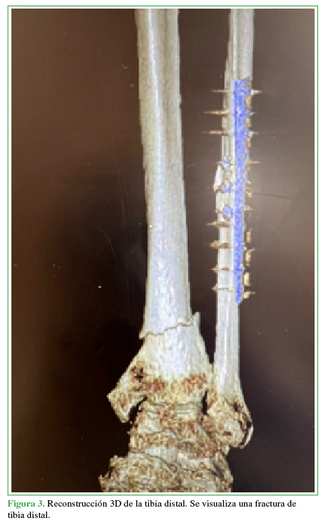 Reconstrucción 3D de la tibia distal.
Se visualiza una fractura de tibia distal.