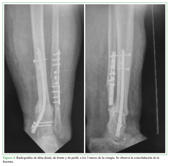 Radiografías de tibia distal, de
frente y de perfil, a los 3 meses de la cirugía. Se observa la consolidación de
la fractura.