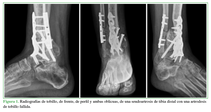 Radiografías de tobillo, de frente, de
perfil y ambas oblicuas, de una seudoartrosis de tibia distal con una
artrodesis de tobillo fallida.
