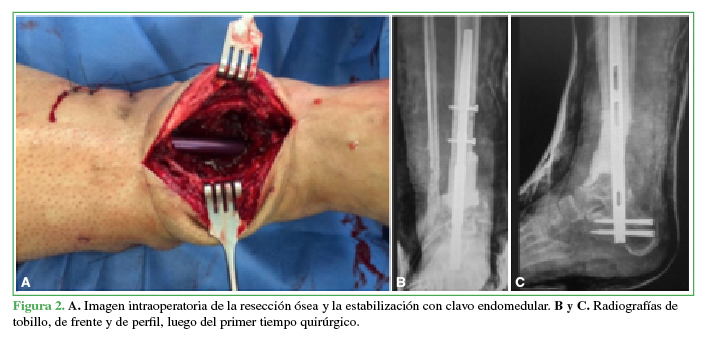 A. Imagen
intraoperatoria de la resección ósea y la estabilización con clavo endomedular.
B y C. Radiografías de tobillo, de
frente y de perfil, luego del primer tiempo quirúrgico.
