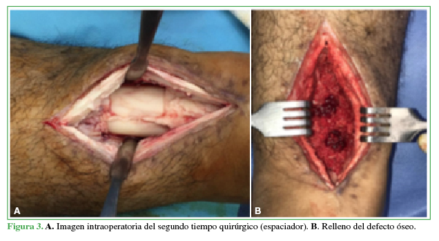 A. Imagen
intraoperatoria del segundo tiempo quirúrgico (espaciador). B. Relleno del defecto óseo.