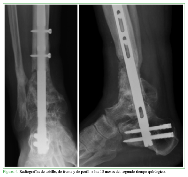 Radiografías de tobillo, de frente y de perfil, a los
13 meses del segundo tiempo quirúrgico.