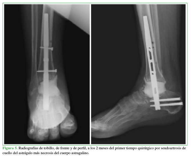  Radiografías de tobillo, de frente y
de perfil, a los 2 meses del primer tiempo quirúrgico por seudoartrosis de
cuello del astrágalo más necrosis del cuerpo astragalino.