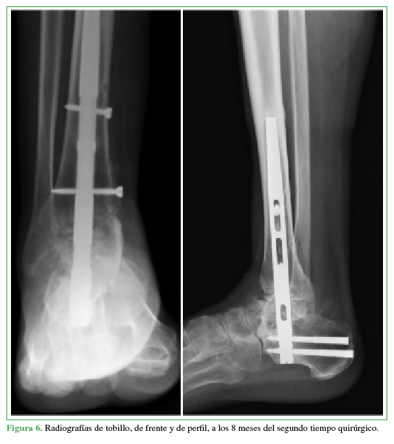 Radiografías de tobillo, de frente y
de perfil, a los 8 meses del segundo
tiempo quirúrgico.