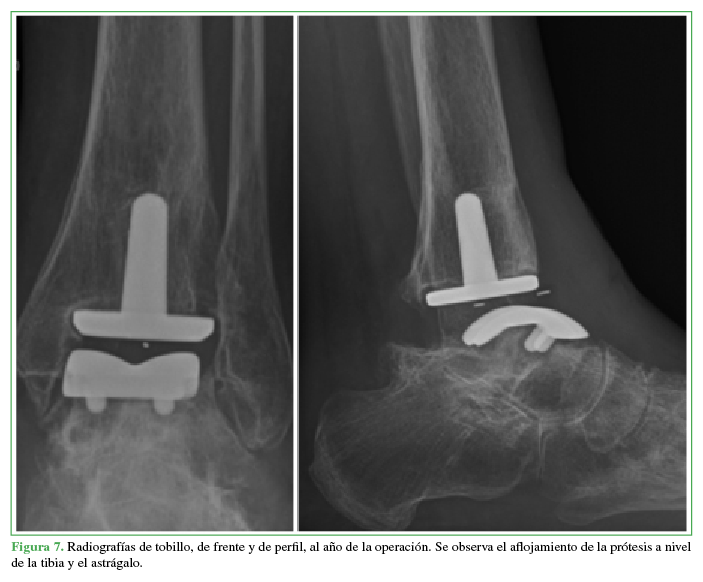 Radiografías de tobillo, de frente y
de perfil, al año de la operación. Se observa el aflojamiento de la prótesis a
nivel de la tibia y el astrágalo.