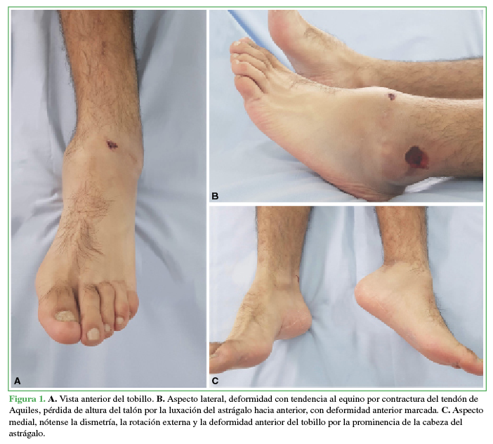A. Vista anterior del
tobillo. B. Aspecto lateral,
deformidad con tendencia al equino por contractura del tendón de Aquiles,
pérdida de altura del talón por la luxación del astrágalo hacia anterior, con
deformidad anterior marcada. C.
Aspecto medial, nótense la dismetría, la rotación externa y la deformidad
anterior del tobillo por la prominencia de la cabeza del astrágalo