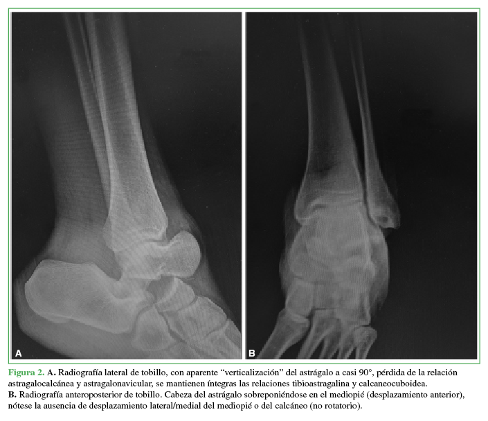 A. Radiografía lateral
de tobillo, con aparente “verticalización” del astrágalo a casi 90°, pérdida de
la relación astragalocalcánea y astragalonavicular, se mantienen íntegras las
relaciones tibioastragalina y calcaneocuboidea. 

B.
Radiografía anteroposterior de tobillo. Cabeza del astrágalo sobreponiéndose en
el mediopié (desplazamiento anterior), nótese la ausencia de desplazamiento
lateral/medial del mediopié o del calcáneo (no rotatorio).
