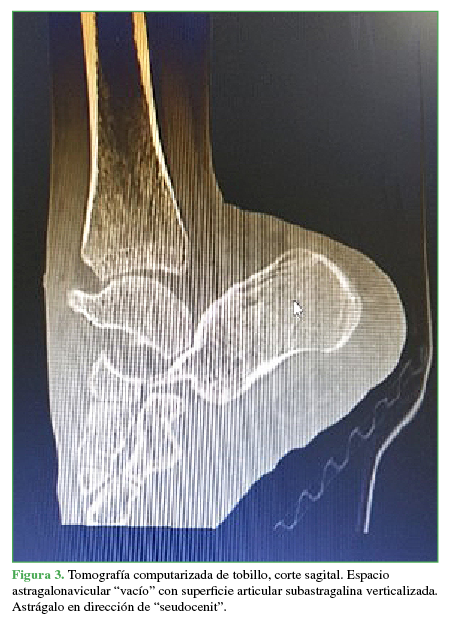 Tomografía computarizada de tobillo,
corte sagital. Espacio astragalonavicular “vacío” con superficie articular
subastragalina verticalizada. Astrágalo en dirección de “seudocenit”.
