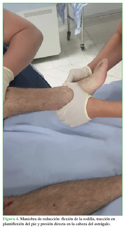Maniobra de reducción: flexión de la
rodilla, tracción en plantiflexión del pie y presión directa en la cabeza del
astrágalo.