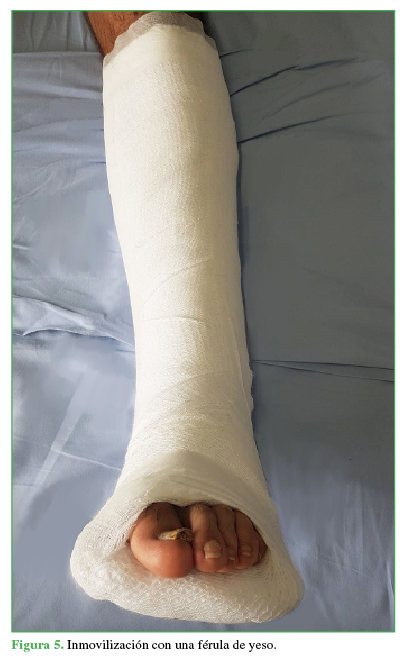 Inmovilización con una férula de yeso.