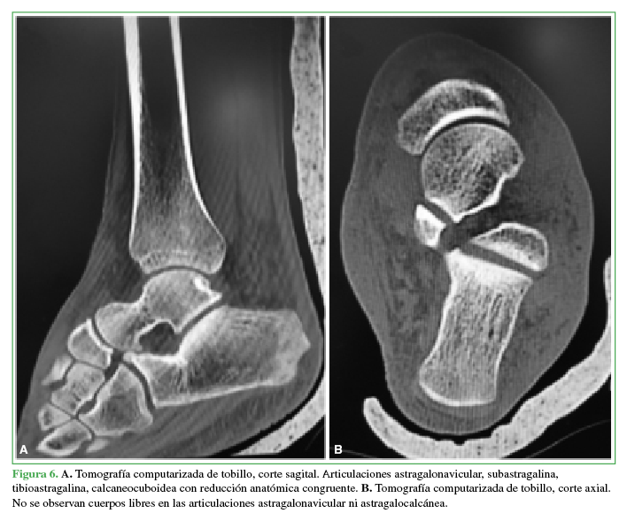 A. Tomografía
computarizada de tobillo, corte sagital. Articulaciones astragalonavicular,
subastragalina, tibioastragalina, calcaneocuboidea con reducción anatómica
congruente. B. Tomografía
computarizada de tobillo, corte axial. No se observan cuerpos libres en las
articulaciones astragalonavicular ni astragalocalcánea.