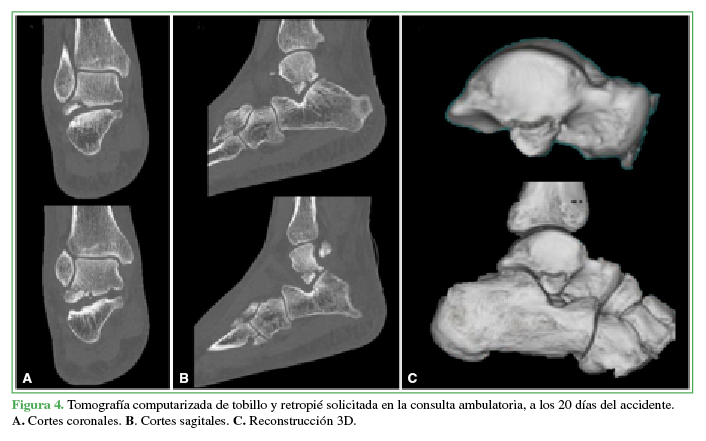 Tomografía computarizada de tobillo y
retropié solicitada en la consulta ambulatoria, a los 20 días del accidente. A. Cortes coronales. B. Cortes sagitales. C.
Reconstrucción 3D