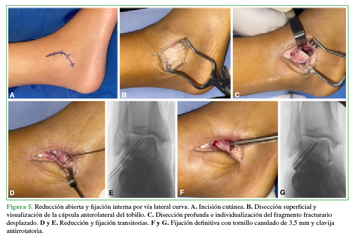  Reducción abierta y fijación interna
por vía lateral curva. A. Incisión
cutánea. B. Disección superficial y
visualización de la cápsula anterolateral del tobillo. C. Disección profunda e individualización del fragmento fracturario
desplazado. D y E. Reducción y
fijación transitorias. F y G.
Fijación definitiva con tornillo canulado de 3,5 mm y clavija antirrotatoria.