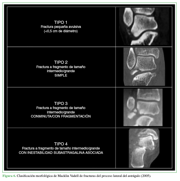 Clasificación morfológica de Macklin Vadell de fracturas del
proceso lateral del astrágalo (2005)