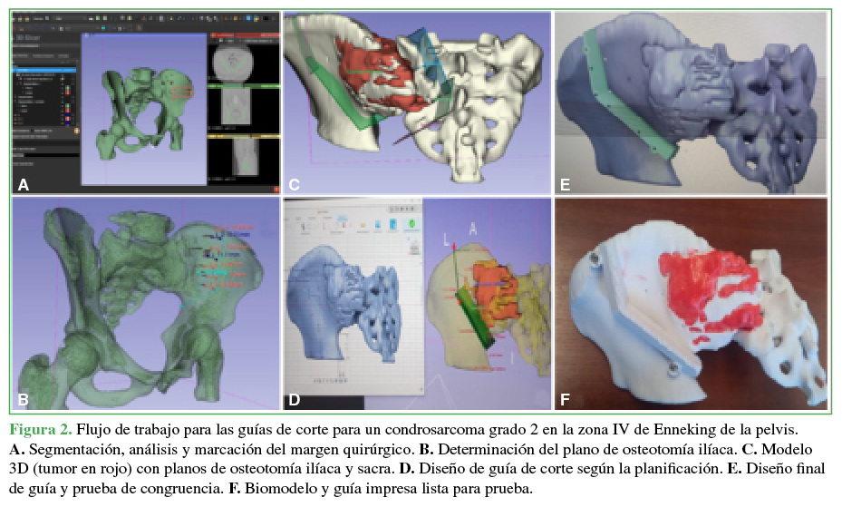 Flujo de trabajo para las guías de corte para un
condrosarcoma grado 2 en la zona IV de Enneking de la
pelvis. A. Segmentación, análisis y
marcación del margen quirúrgico. B.
Determinación del plano de osteotomía ilíaca. C. Modelo 3D (tumor en rojo) con planos de osteotomía ilíaca y
sacra. D. Diseño de guía de corte
según la planificación. E. Diseño
final de guía y prueba de congruencia. F. Biomodelo y guía impresa lista para prueba. 

 