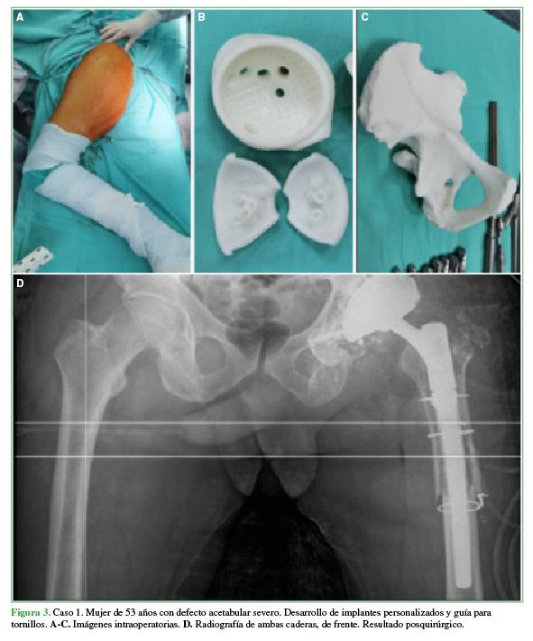 Caso 1. Mujer de 53 años con defecto acetabular severo.
Desarrollo de implantes personalizados y guía para tornillos. A,B,C. Imágenes intraoperatorias. D. Radiografía de ambas caderas, de
frente. Resultado posquirúrgico. 

 