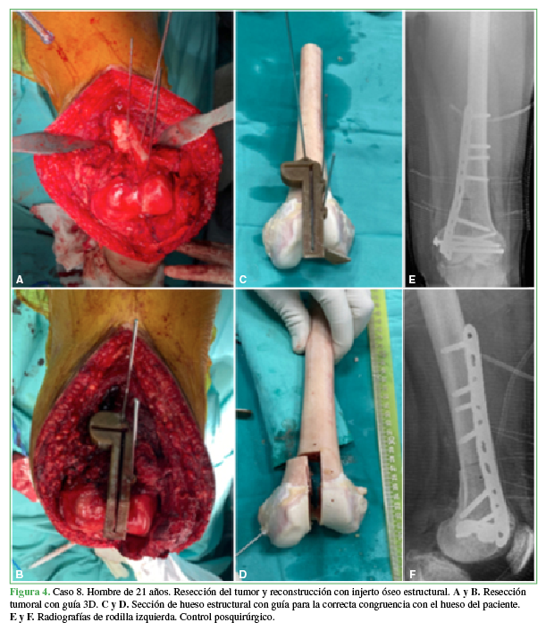 Caso 8. Hombre de 21 años. Resección del tumor y
reconstrucción con injerto óseo estructural. A y B. Resección tumoral con guía 3D. C y D. Sección de hueso estructural con guía para la correcta
congruencia con el hueso del paciente. E
y F. Radiografías de rodilla izquierda. Control posquirúrgico.