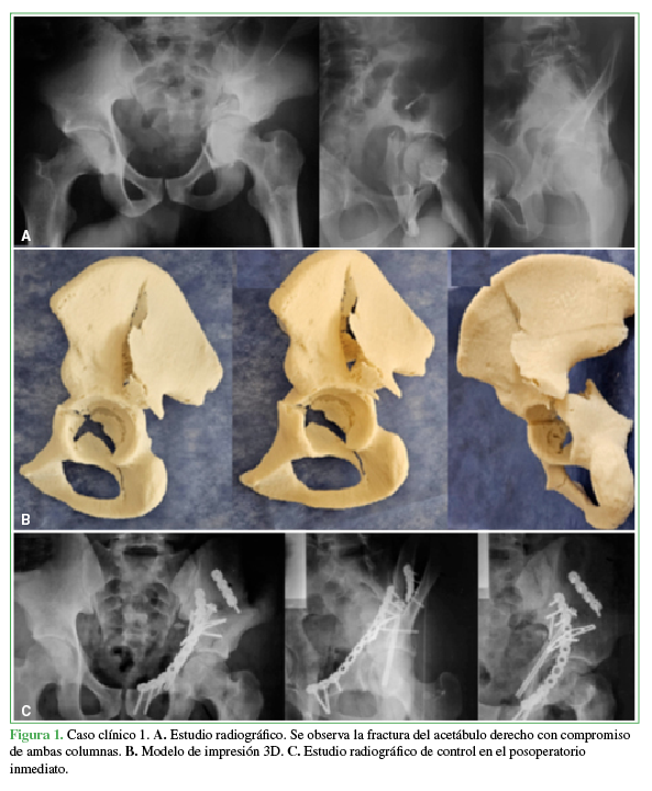  Caso clínico 1. A.
Estudio radiográfico. Se observa la fractura del acetábulo derecho con
compromiso de ambas columnas. B.
Modelo de impresión 3D. C. Estudio
radiográfico de control en el posoperatorio inmediato.