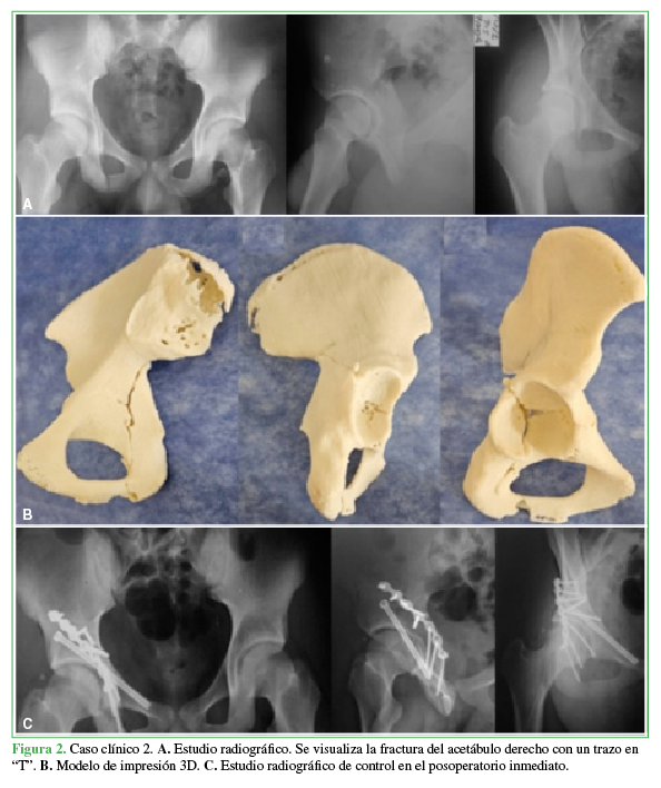 Caso clínico 2. A.
Estudio radiográfico. Se visualiza la fractura del acetábulo derecho con un
trazo en “T”. B. Modelo de impresión
3D. C. Estudio radiográfico de
control en el posoperatorio inmediato.