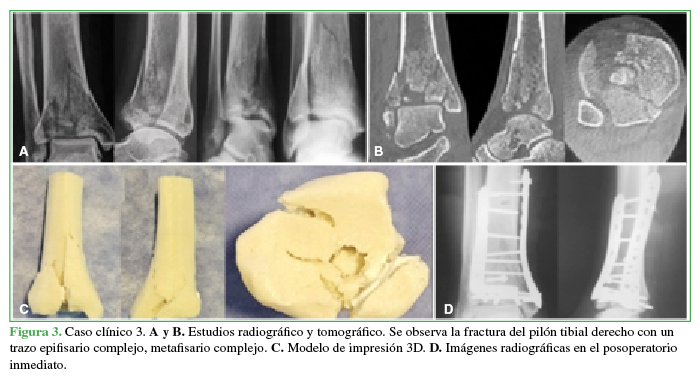 Caso clínico 3. A
y B. Estudios radiográfico y tomográfico. Se observa la fractura del pilón
tibial derecho con un trazo epifisario complejo, metafisario complejo. C. Modelo de impresión 3D. D. Imágenes radiográficas en el
posoperatorio inmediato.