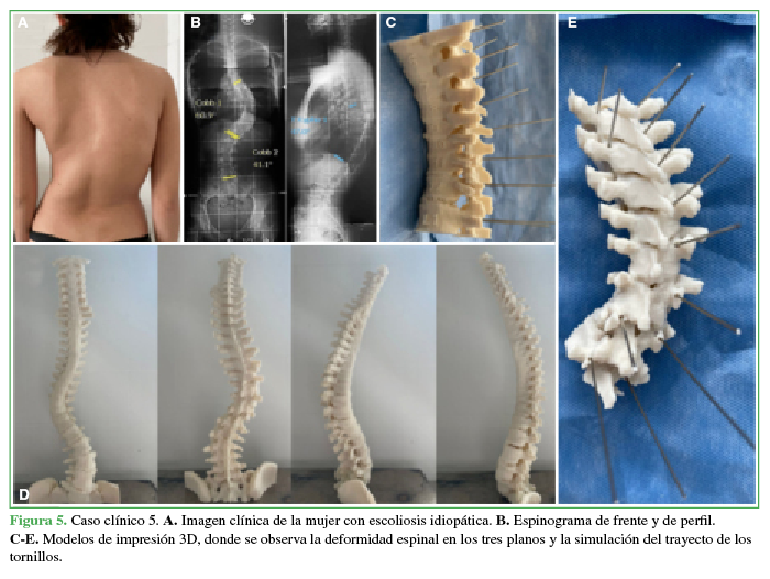 Caso clínico 5. A.
Imagen clínica de la mujer con escoliosis idiopática. B. Espinograma de frente y de perfil. C-E. Modelos de impresión 3D, donde
se observa la deformidad espinal en los tres planos y la simulación del
trayecto de los tornillos.