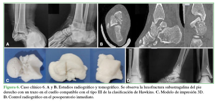 Caso clínico 6. A
y B. Estudios radiográfico y tomográfico. Se observa la luxofractura subastragalina del pie derecho con un trazo en el
cuello compatible con el tipo III de la clasificación de Hawkins. C. Modelo de impresión 3D. D. Control radiográfico en el
posoperatorio inmediato.