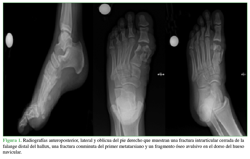 Radiografías
anteroposterior, lateral y oblicua del pie derecho que muestran una fractura intrarticular cerrada de la falange distal del hallux, una fractura conminuta del primer metatarsiano y un
fragmento óseo avulsivo en el dorso del hueso navicular.