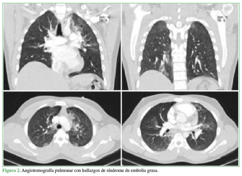 Angiotomografía
pulmonar con hallazgos de síndrome de embolia grasa.