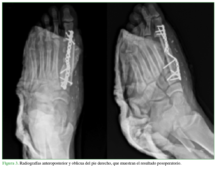 Radiografías
anteroposterior y oblicua del pie derecho, que muestran el resultado
posoperatorio.