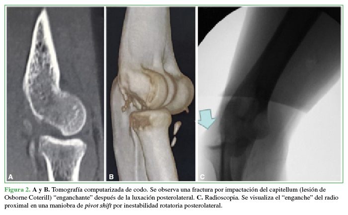 A y B.
Tomografía computarizada de codo. Se observa una fractura por impactación del
capitellum (lesión de Osborne Coterill) “enganchante” después de la luxación
posterolateral. C. Radioscopia. Se
visualiza el “enganche” del radio proximal en una maniobra de pivot shift por inestabilidad rotatoria
posterolateral.