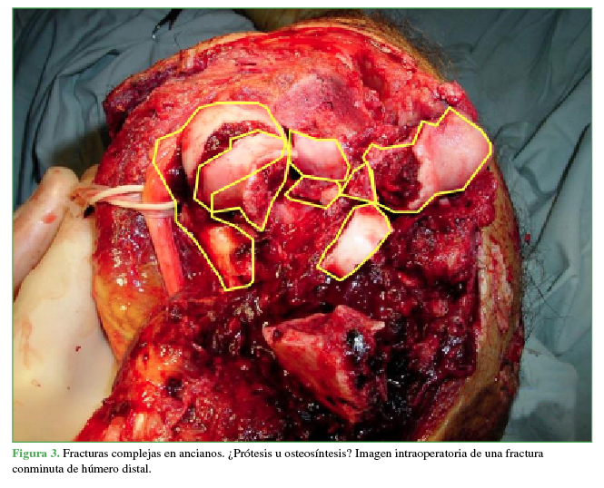 Fracturas complejas en ancianos. ¿Prótesis u
osteosíntesis? Imagen intraoperatoria de una fractura conminuta de húmero
distal.