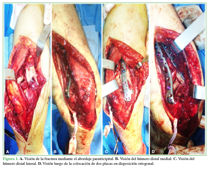  A.
Visión de la fractura mediante el abordaje paratricipital. B. Visión del húmero distal medial. C. Visión del húmero distal lateral. D. Visión luego de la colocación de dos placas en disposición
ortogonal.