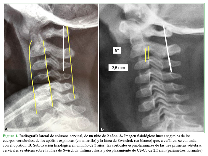 Radiografía lateral de columna cervical, de un niño de 2 años. A. Imagen fisiológica: líneas sagitales de los cuerpos vertebrales, de las apófisis espinosas (en amarillo) y la línea de Swischuk (en blanco) que, a cefálico, se continúa con el opistion. B. Subluxación fisiológica en un niño de 3 años, las corticales espinolaminares de las tres primeras vértebras cervicales se ubican sobre la línea de Swischuk. Ínfima cifosis y desplazamiento de C2-C3 de 2,5 mm (parámetros normales)